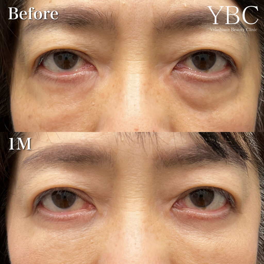 モフィウス8後のクマ治療