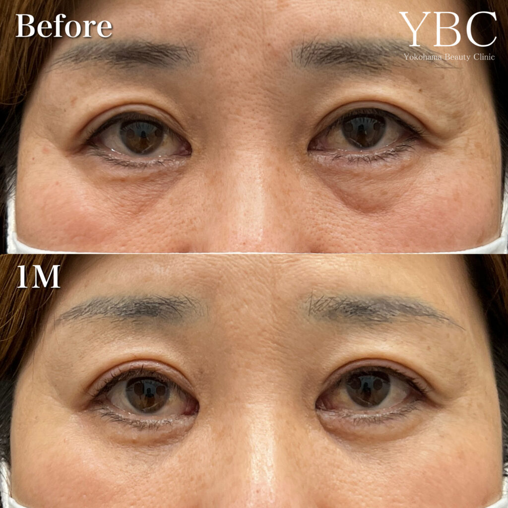 マドンナリフト後のクマ治療