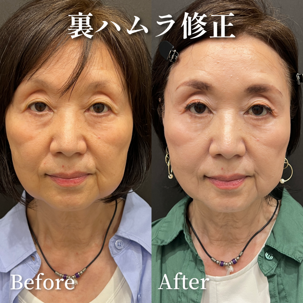 裏ハムラ法修正