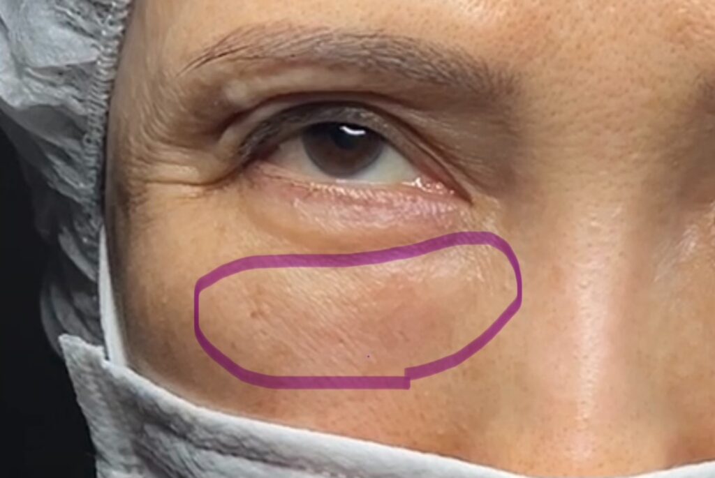 脂肪注入後の目の下のしこり