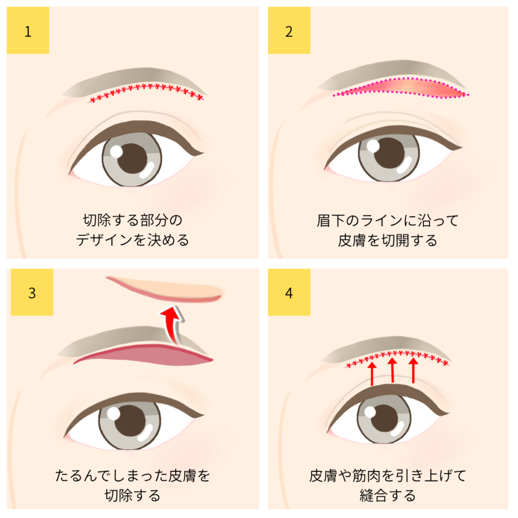 眉下リフト施術方法
