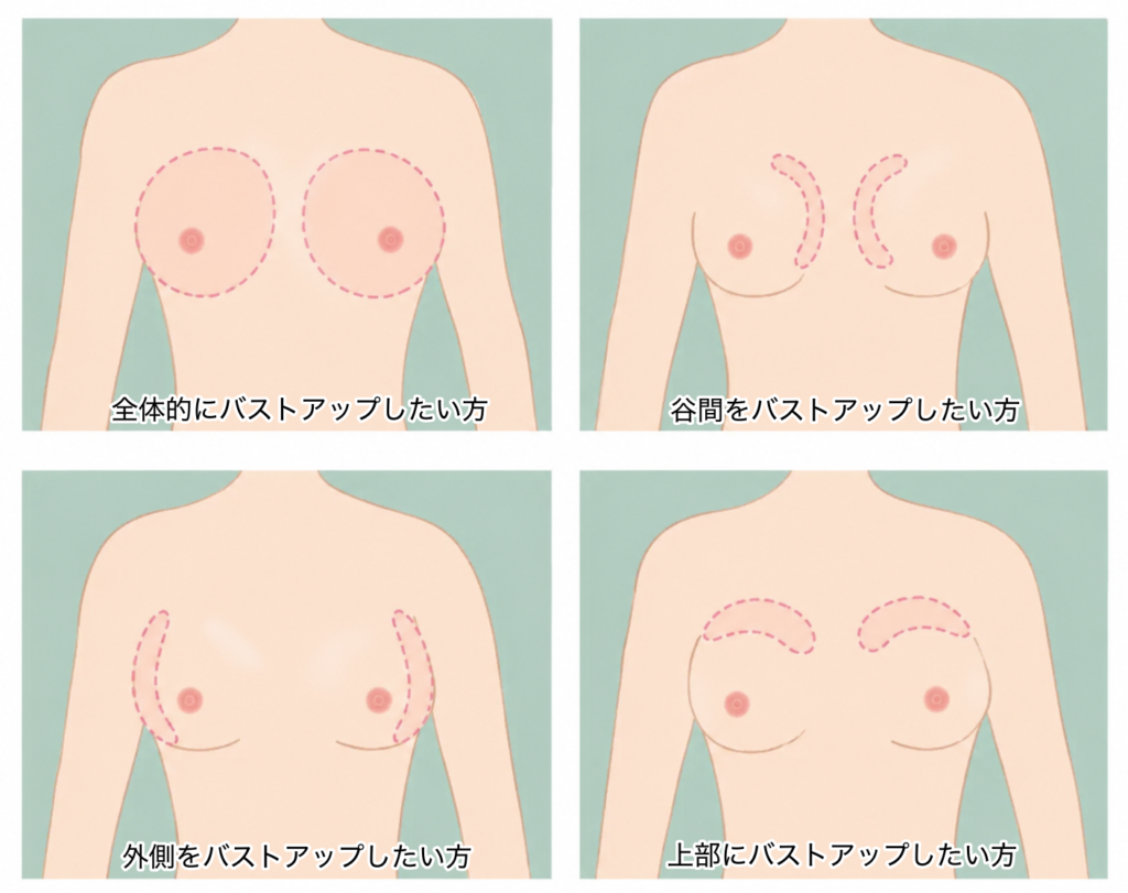 ヒアルロン酸豊胸
