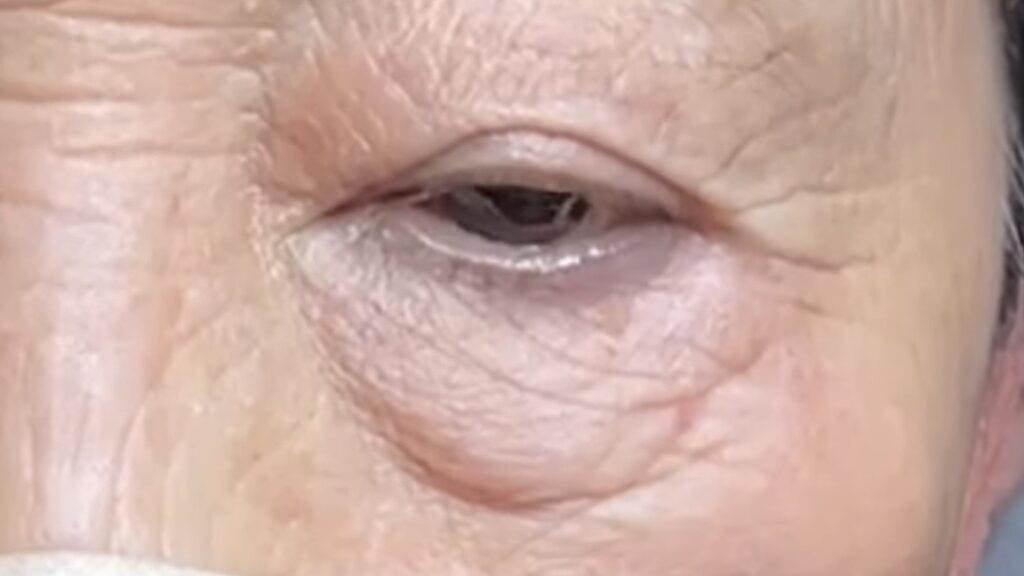 皮膚のハリの低下