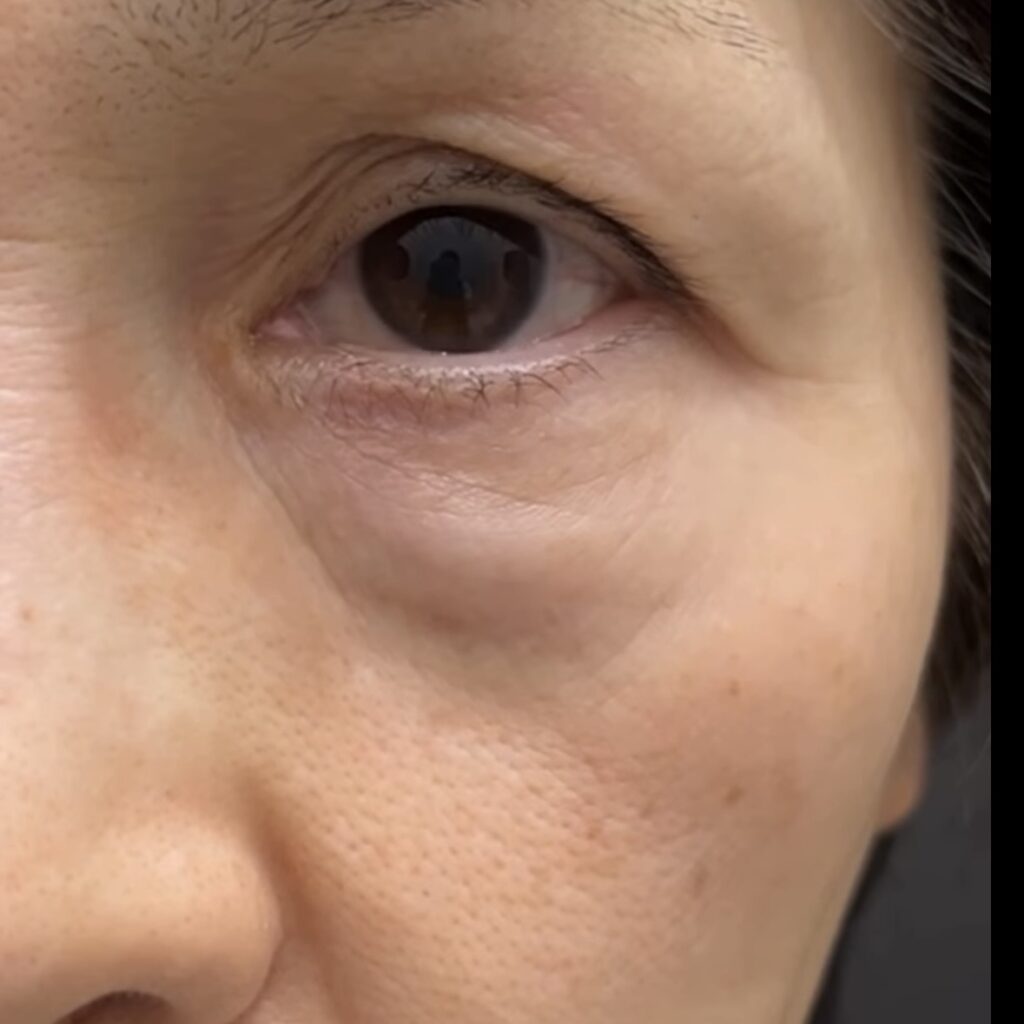 目の下のふくらみと頬の凹み