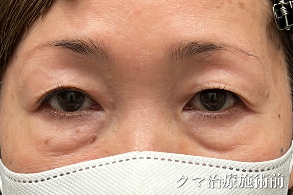 50代のクマ治療前