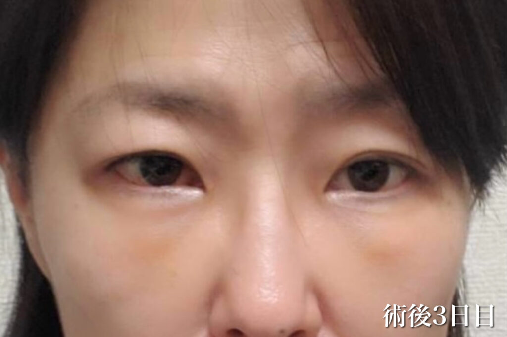 経過写真(術後3日)