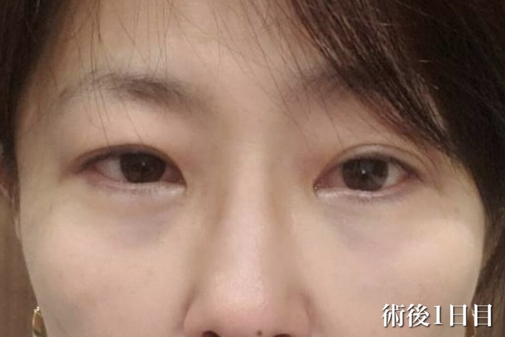 経過写真(術後1日目)