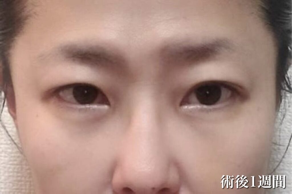 経過写真(術後1週間)