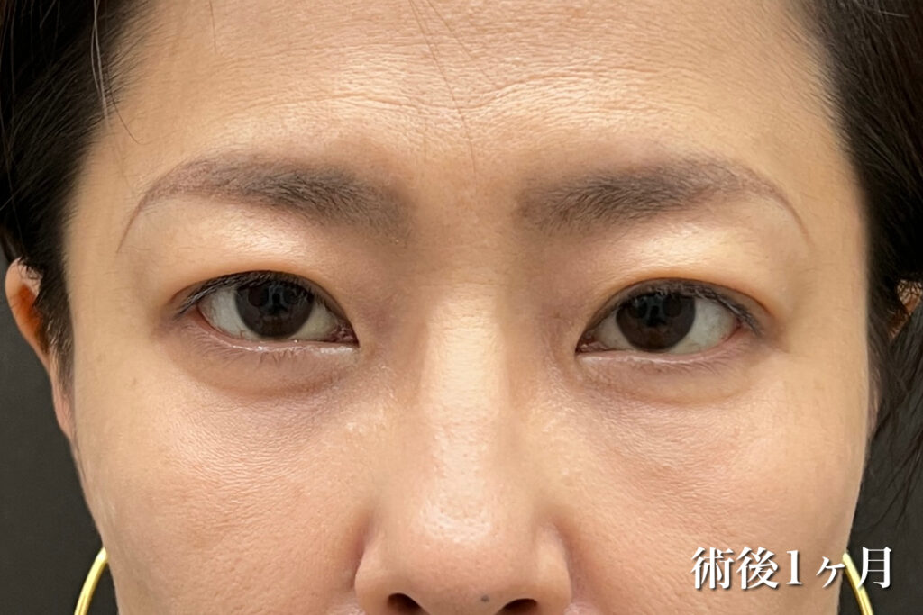経過写真(術後1か月)