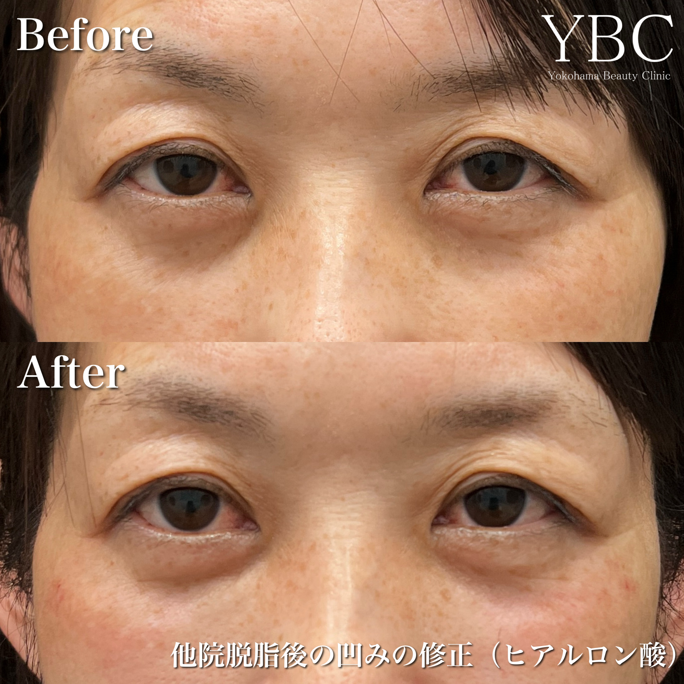 脱脂のみ他院修正（ヒアルロン酸のみ）