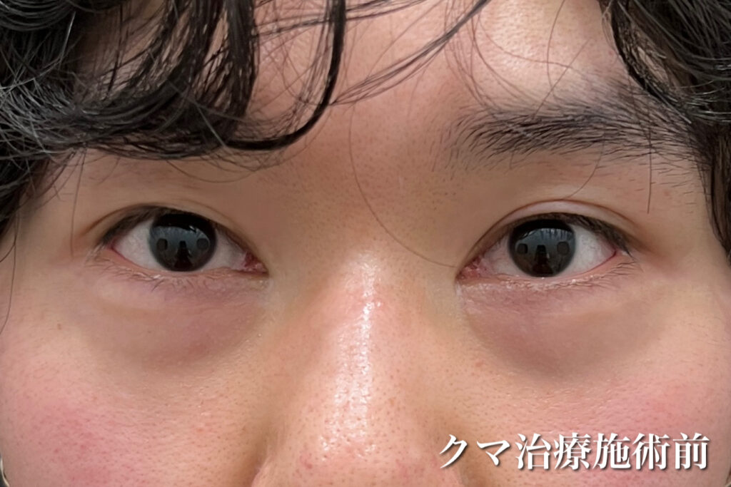 男性のクマ治療前