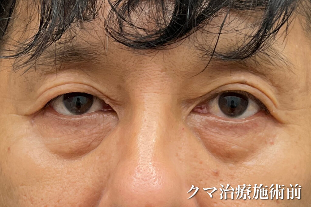 男性のクマ治療前