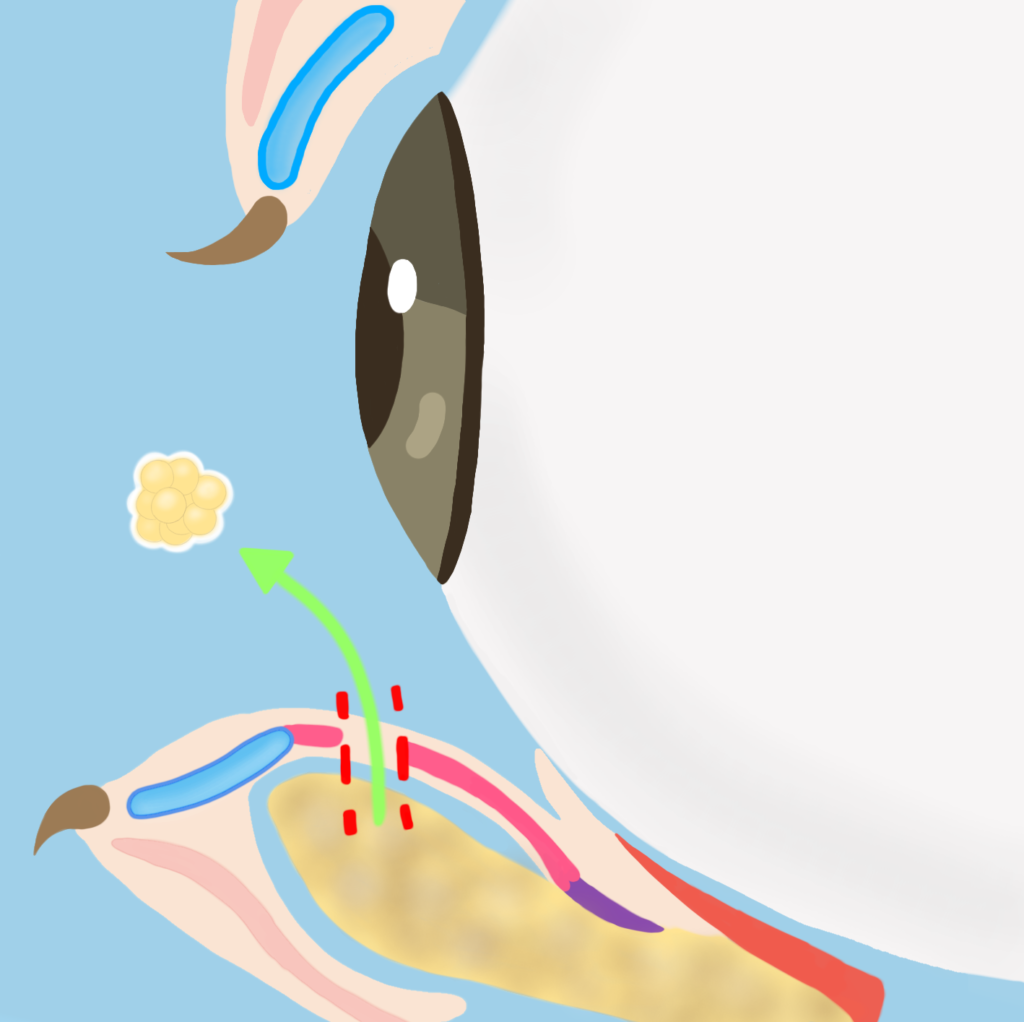 経結膜脱疽シェーマ
