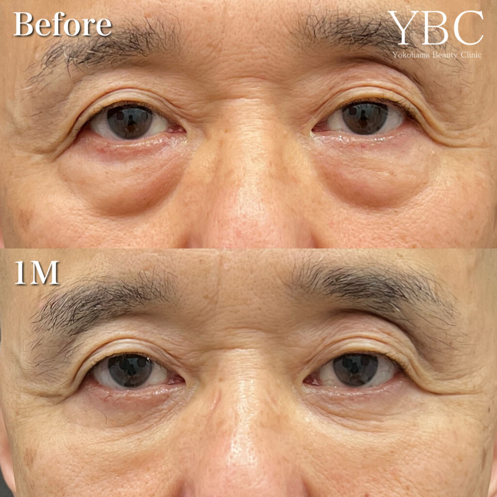 60代男性クマ症例