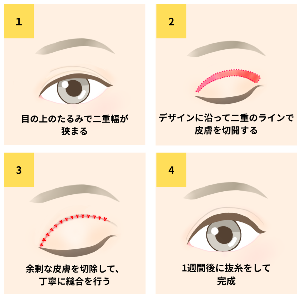 目の上のたるみ取り施術内容