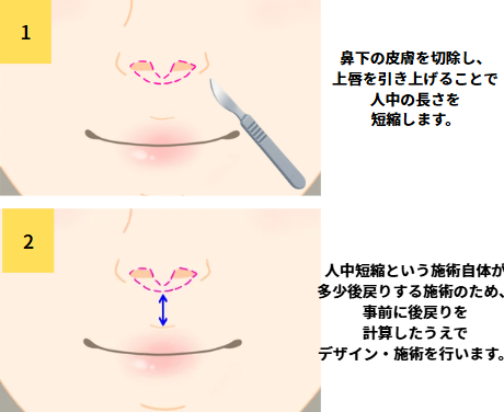 人中短縮施術方法