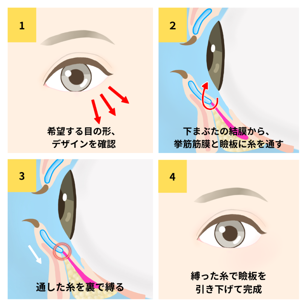 切らないたれ目形成 施術方法