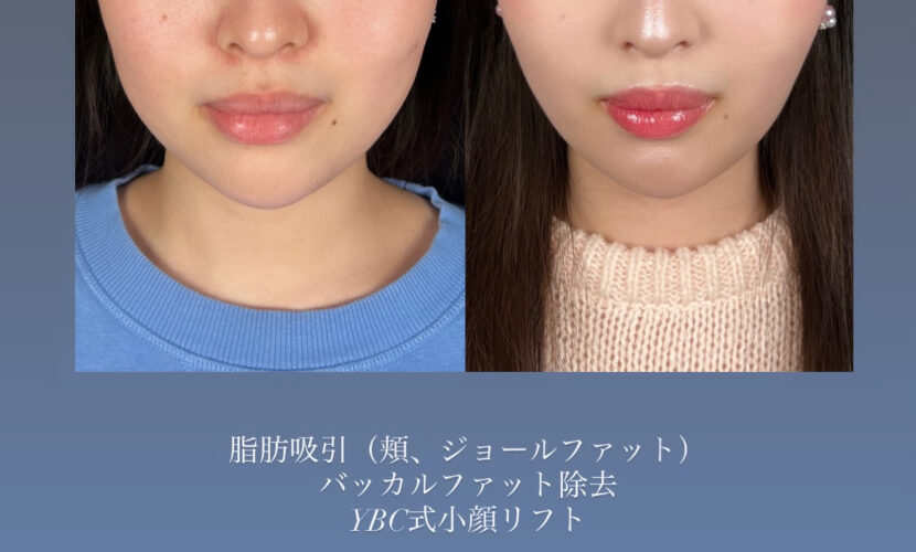脂肪吸引