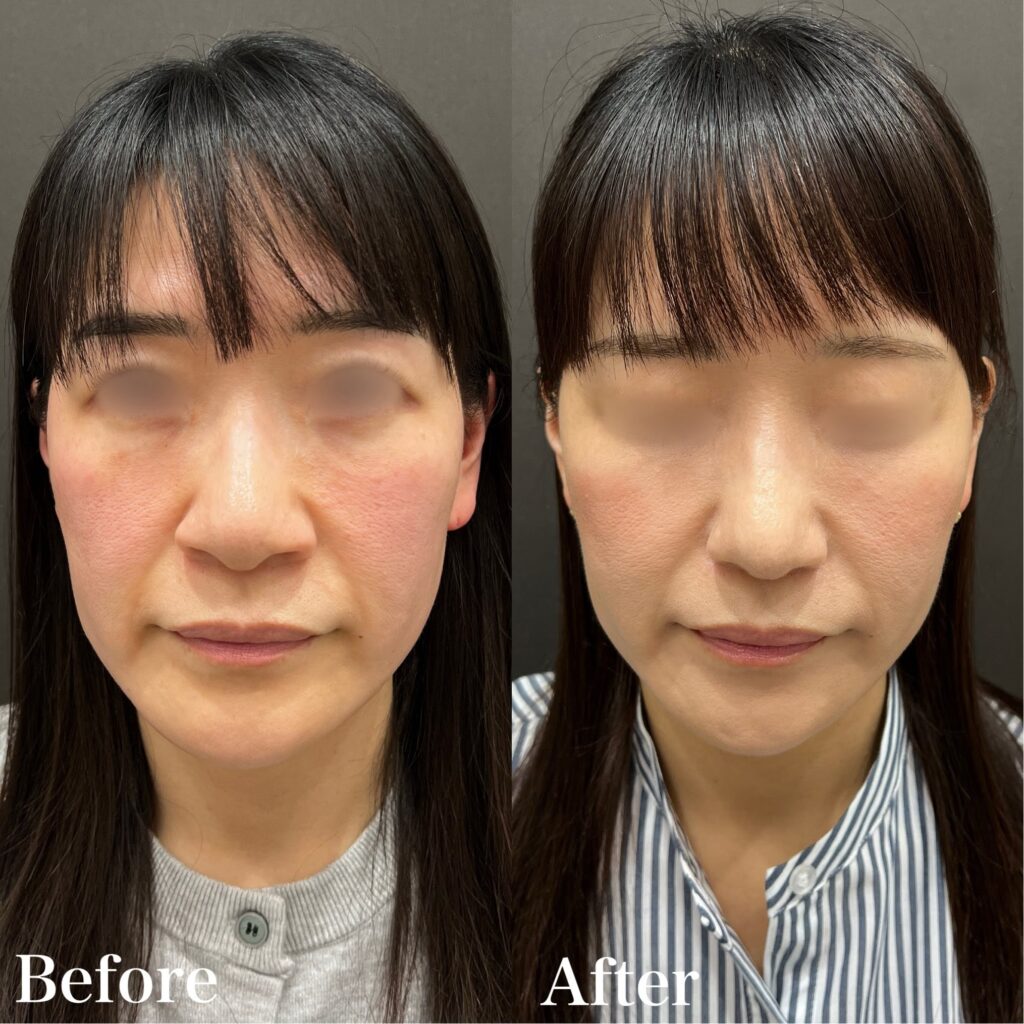 鼻整形の症例画像