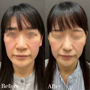 鼻整形の症例画像