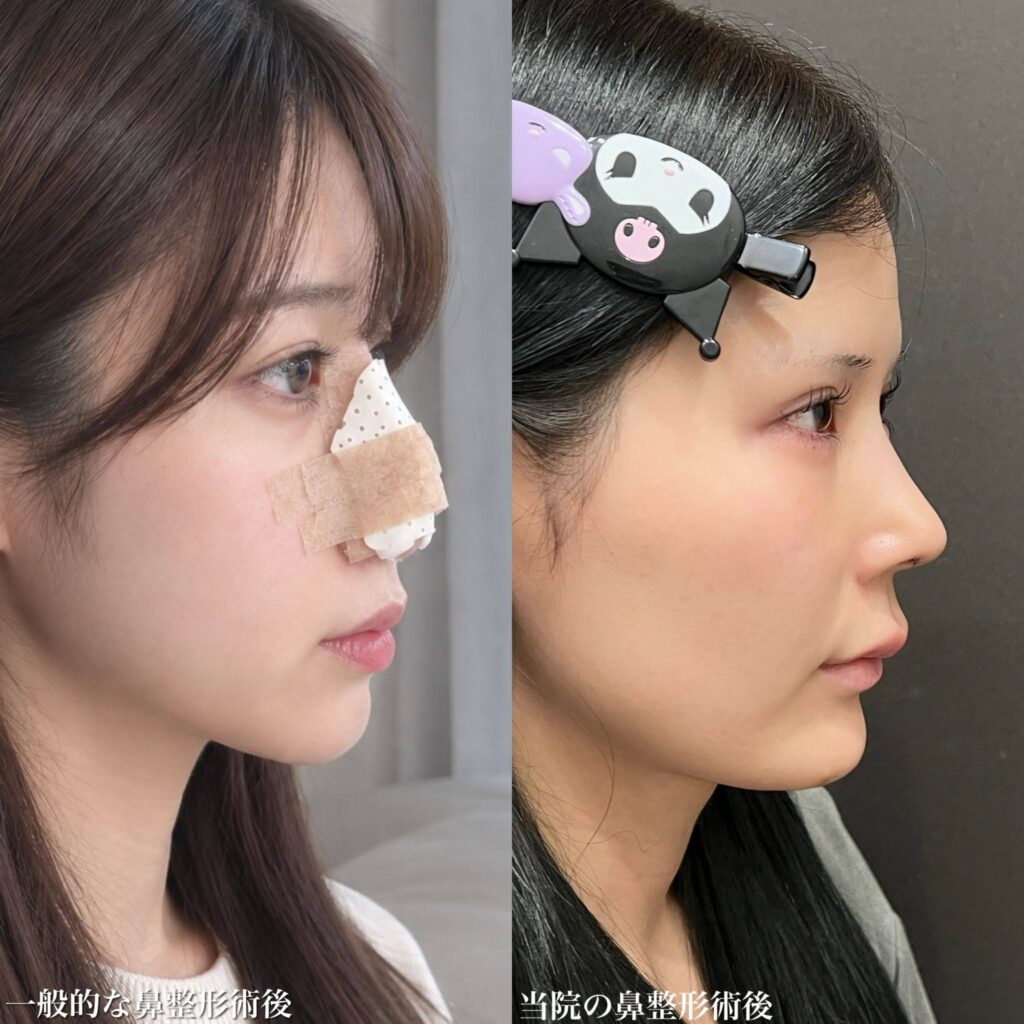 ギプスなしの術直後の症例画像