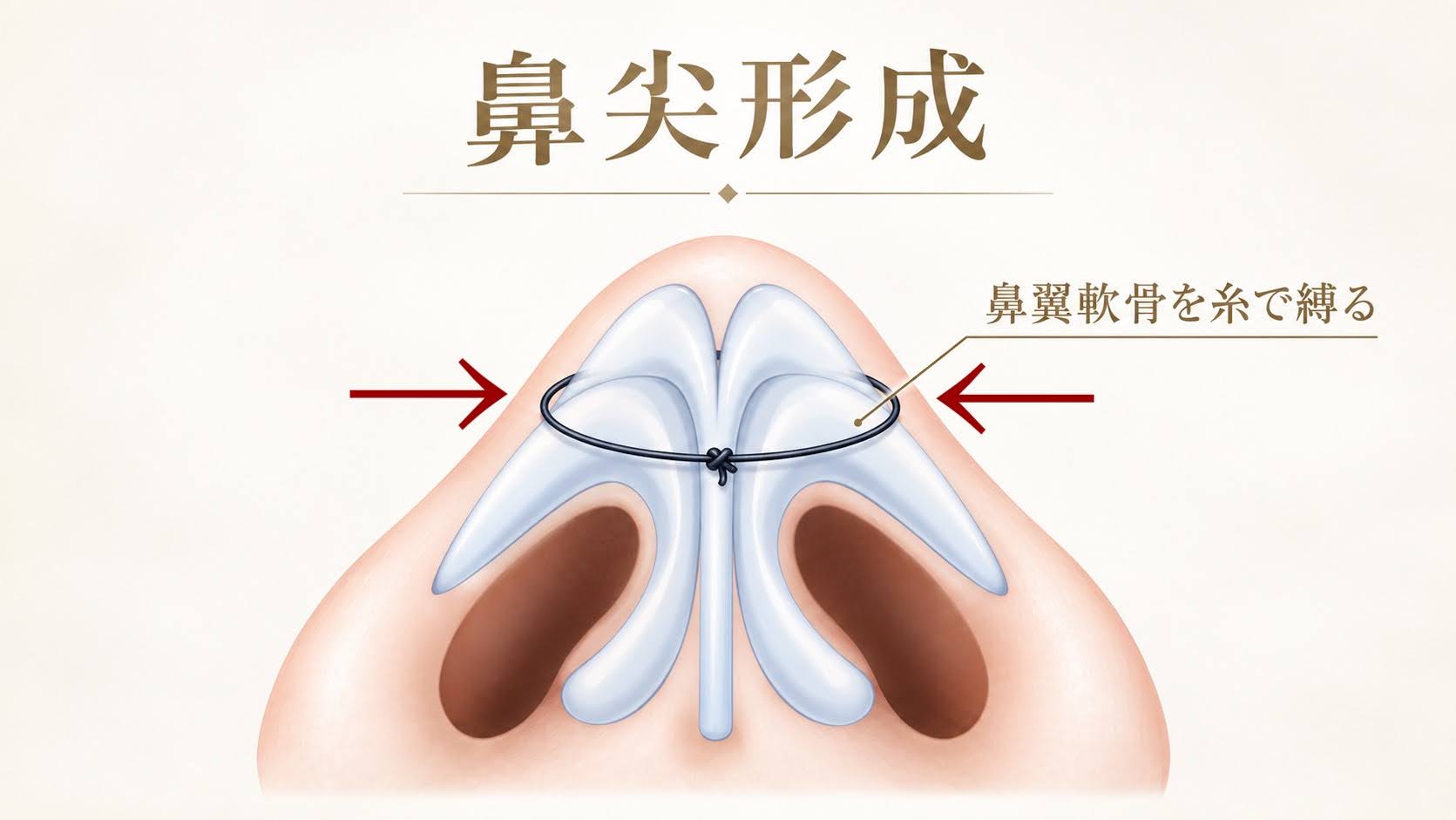 鼻尖形成の施術方法