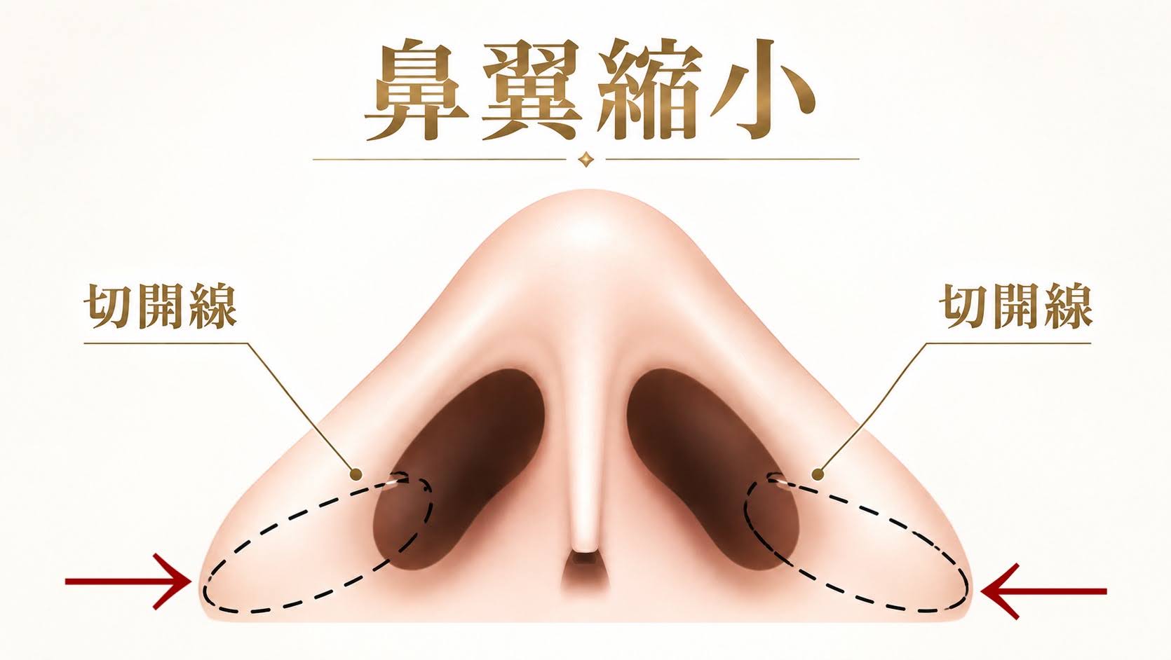 鼻翼縮小の施術方法