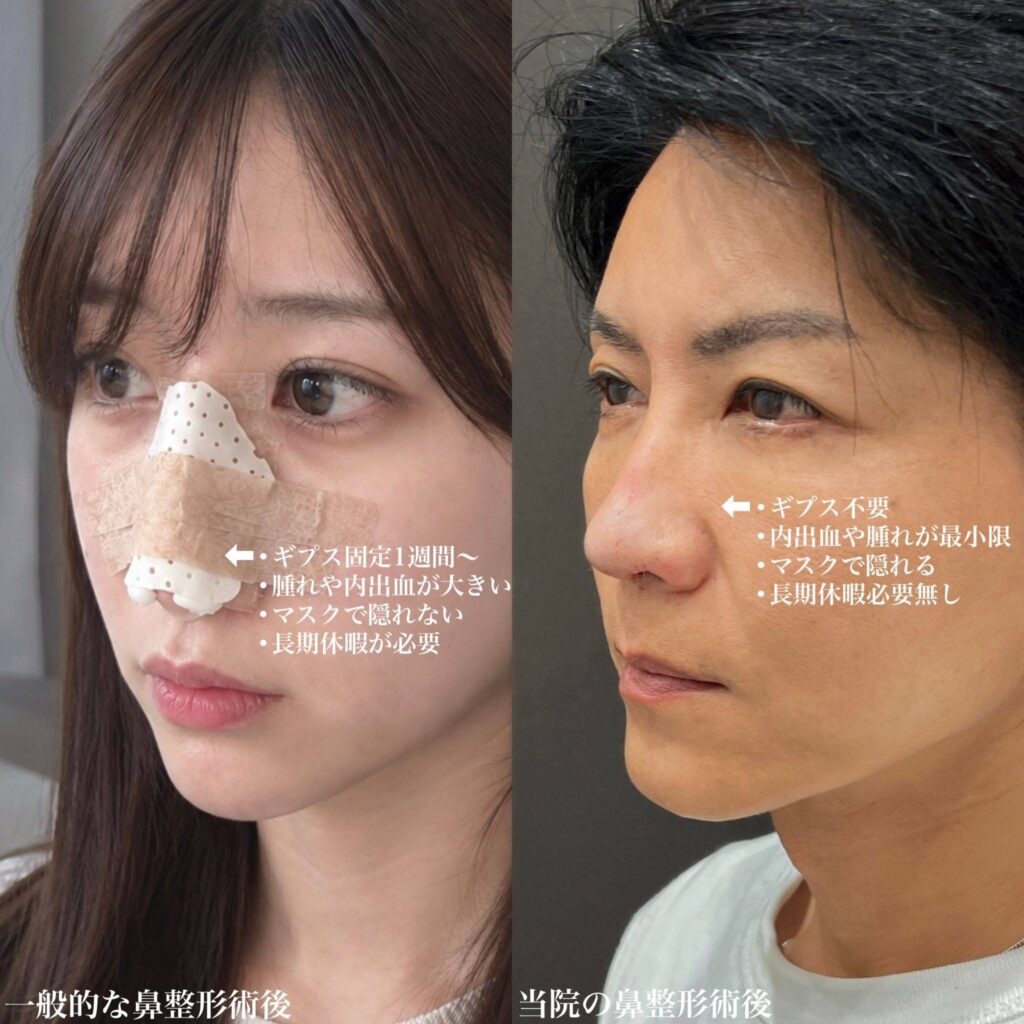 YBCがギプス不要な理由を解説している画像