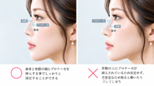 YBC流！一生ものの「バレないプロテーゼ」の極意の図解