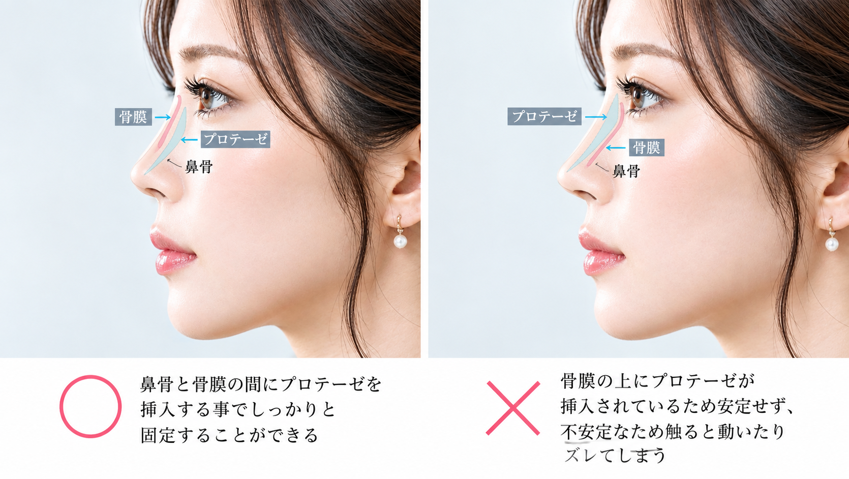 YBC流！一生ものの「バレないプロテーゼ」の極意の図解
